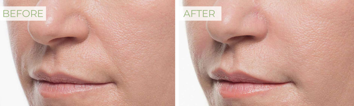 Bellafill in Johnson City TN | Bellafill Lip Filler