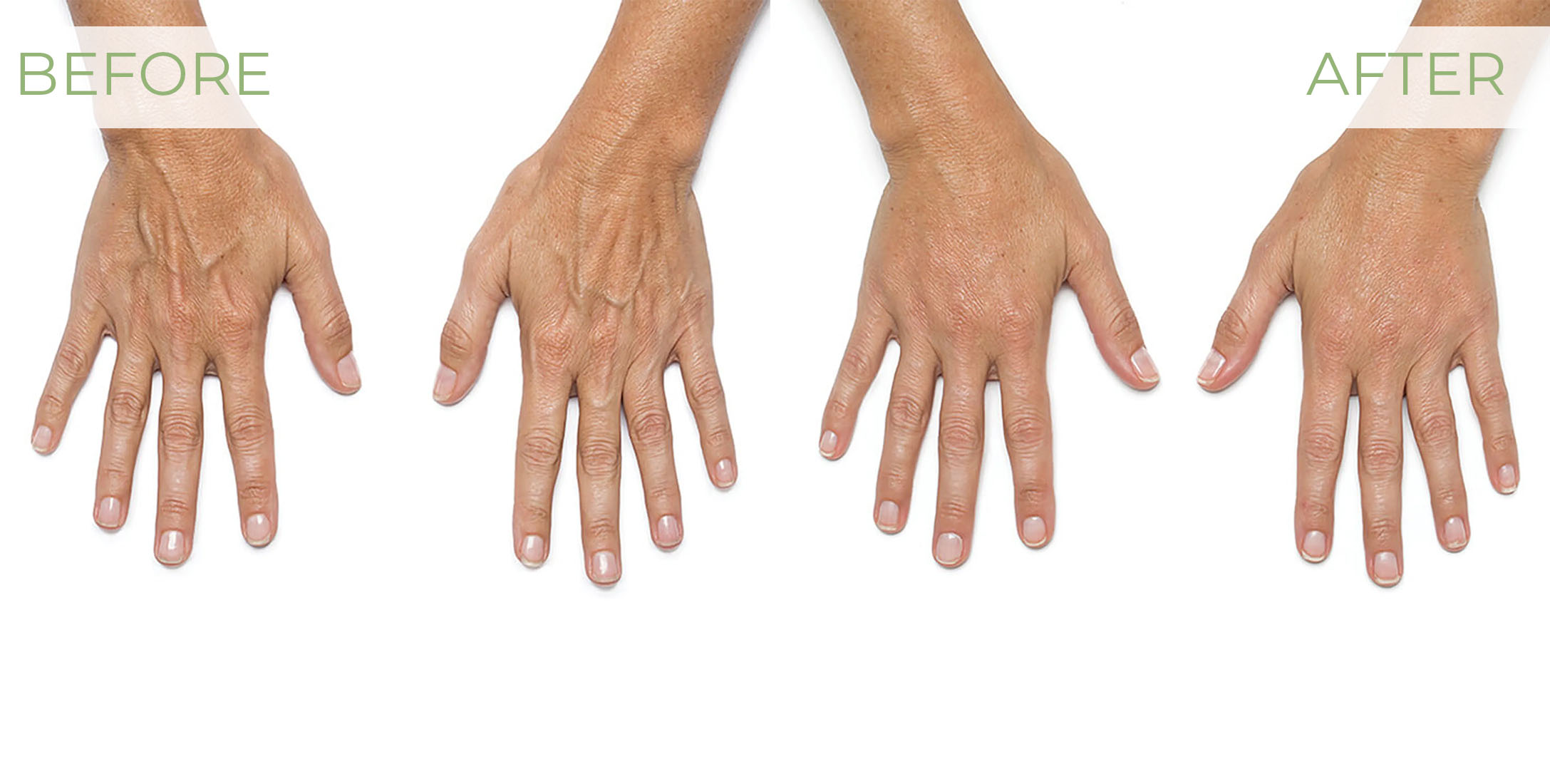 Radiesse before and after of back of hands