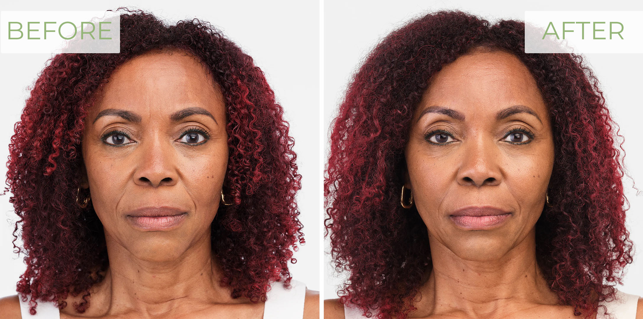 Radiesse before and after of the lower face