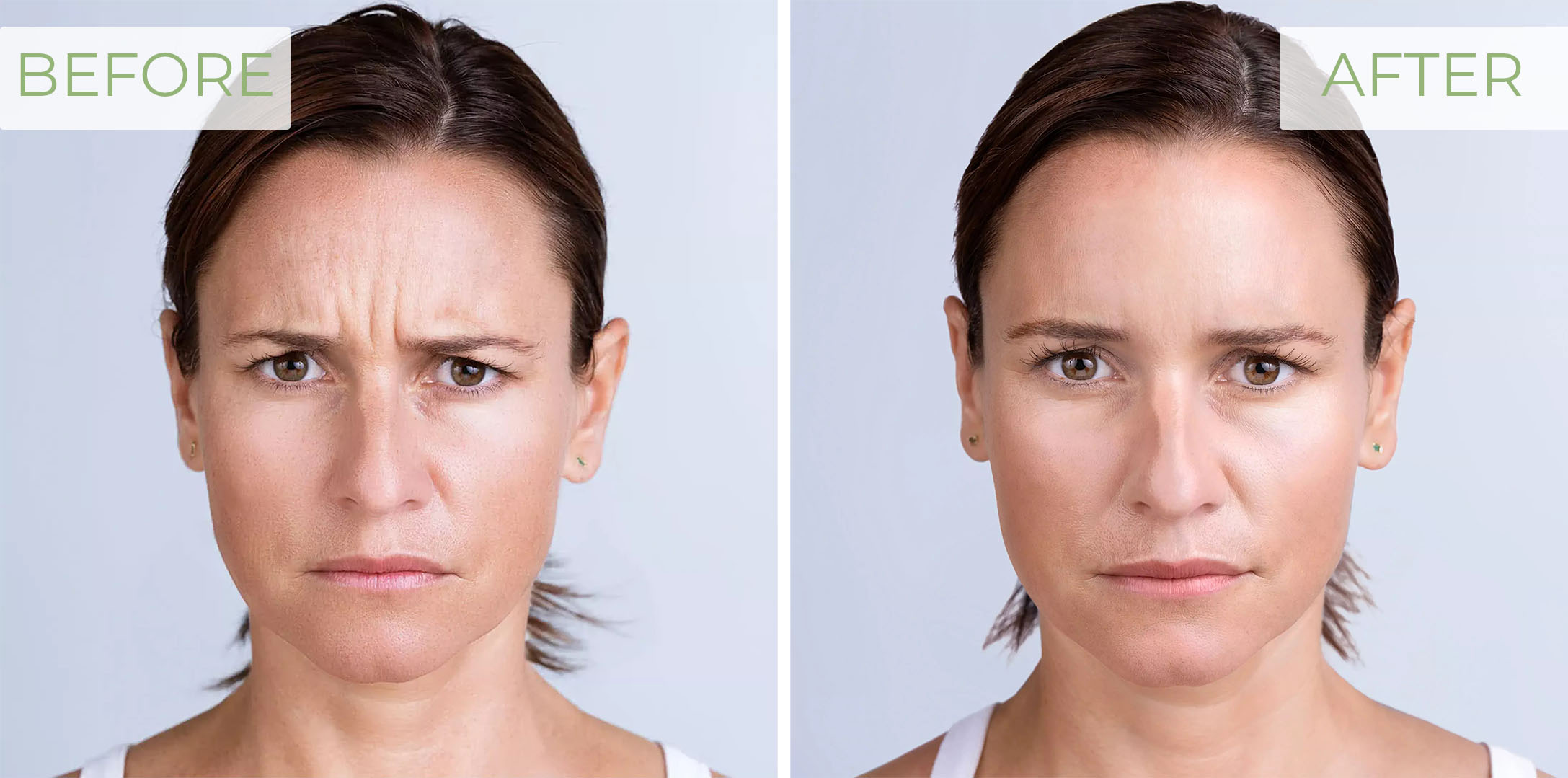 before and after example of Xeomin